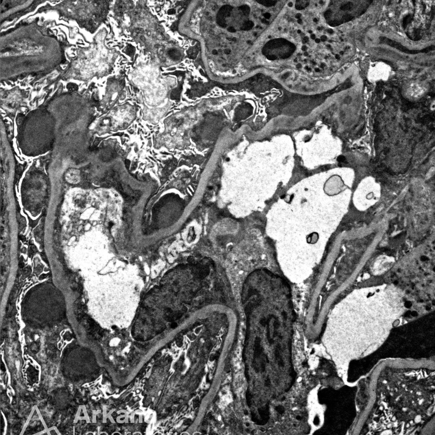 Proliferative Glomerulonephritis With Monoclonal Igg Deposits Arkana