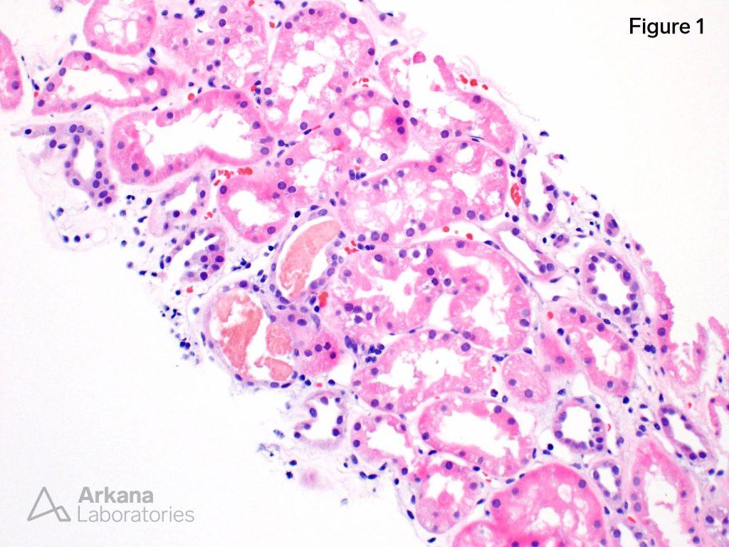 Myoglobin Casts | Teaching Points | Arkana Laboratories