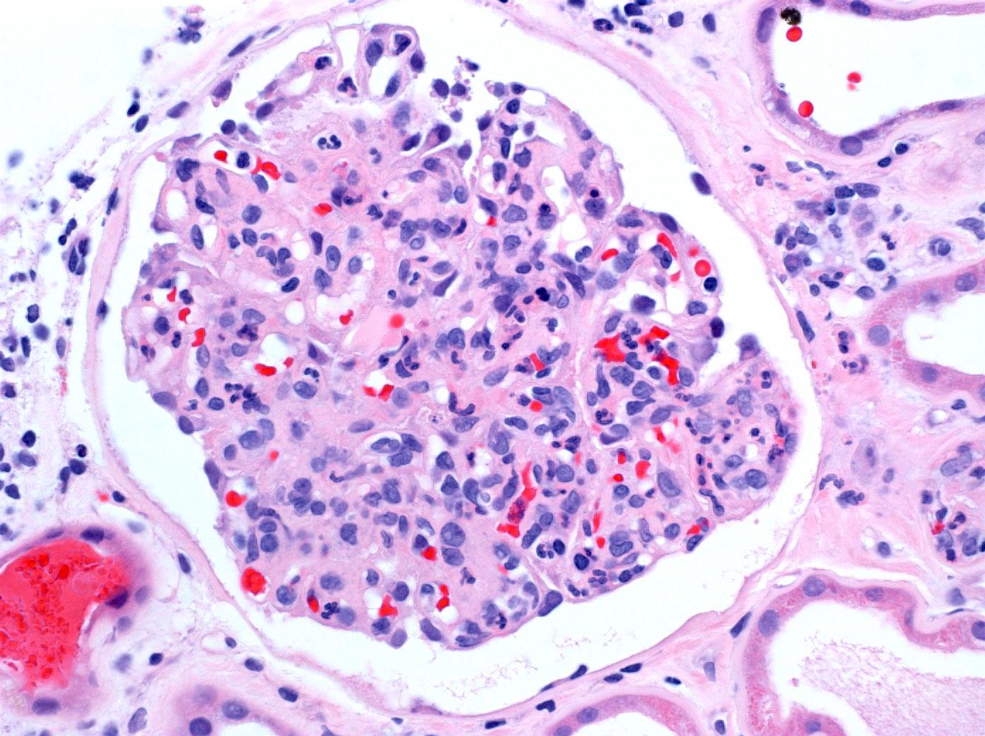 Infection-Associated Glomerulonephritis | Disease Week | Arkana Labs