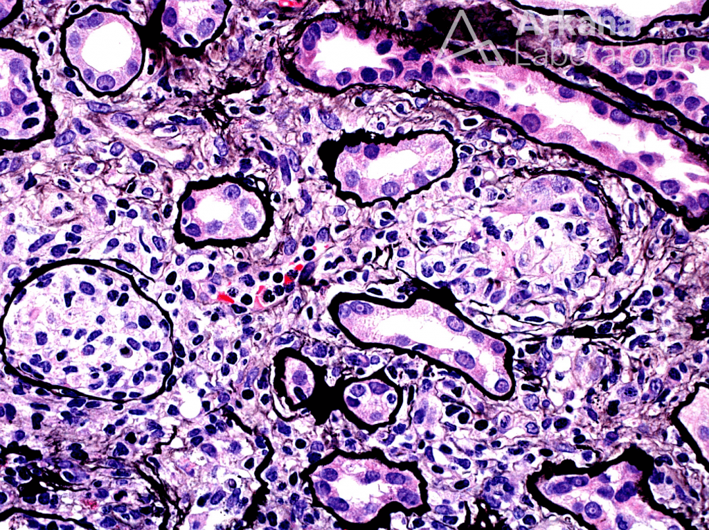 Onco-Nephrology | Disease Week | Arkana Laboratories