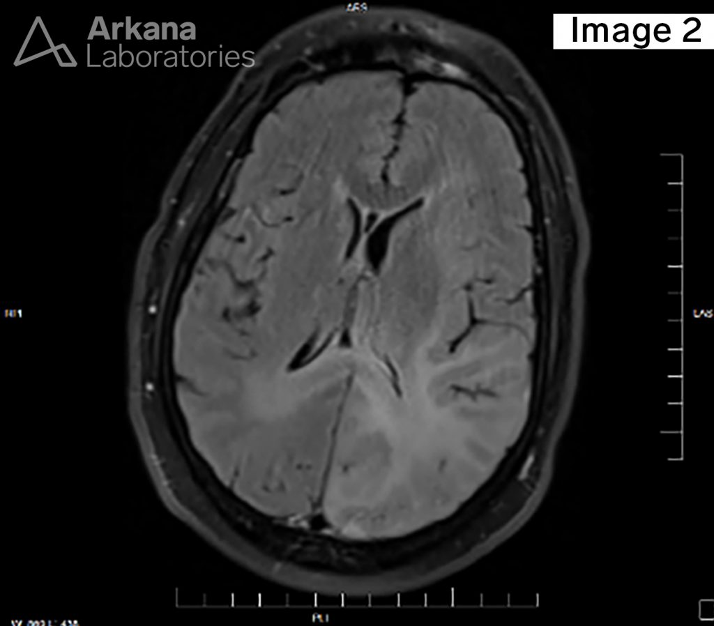 Diffuse Astrocytoma Idh Mutant Neuro Notes Arkana Labs