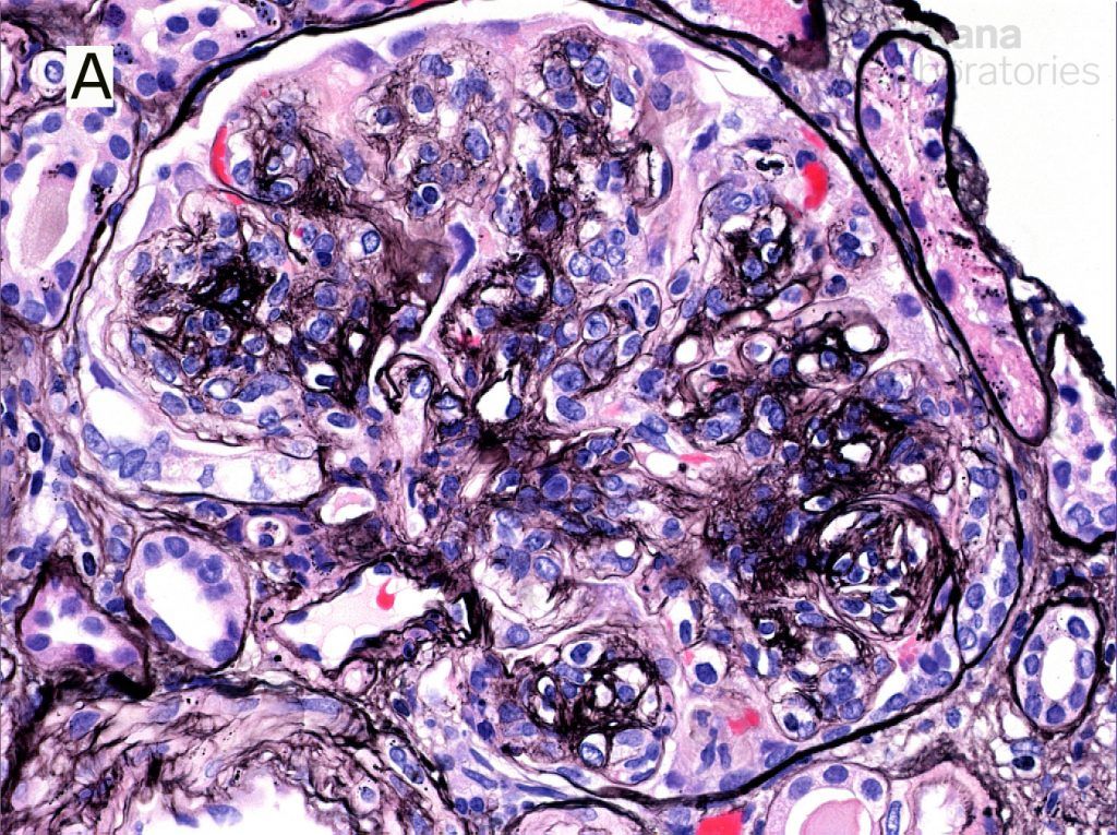 Monoclonal Igg Deposits Teaching Points Arkana Laboratories