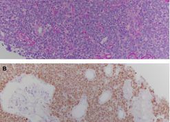 Diffuse renal parenchymal infiltration by B cell acute lymphoblastic leukemia blasts
