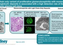 Light chain only variant of proliferative glomerulonephritis