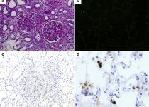 De Novo ANCA-Associated Vasculitis With Glomerulonephritis in COVID-19