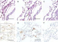 SARS-CoV-2 IHC and ISH in lung.