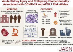 AKI and Collapsing Glomerulopathy Associated with COVID-19 and APOL 1 High-Risk Genotype