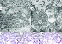 Electron microscopy and in situ hybridization for SARS-CoV-2 reveal no evidence of viral presence in kidney biopsy material