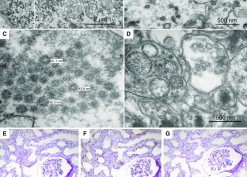 Electron microscopy and in situ hybridization for SARS-CoV-2 reveal no evidence of viral presence in kidney biopsy material