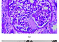ANCA-Associated Necrotizing Glomerulonephritis Overlapping with Mesangial Proliferative Lupus Nephritis