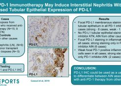 Anti-PD-1 Immunotherapy May Induce Interstitial Nephritis With Increased Tubular Epithelial Expression of PD-L1