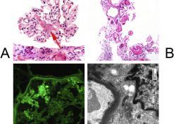 COVID-19-Associated Collapsing Focal Segmental Glomerulosclerosis