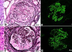 a case of anti–glomerular basement membrane (GBM) disease