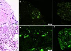 Staining for IgA in kidney biopsy samples with IgA nephropathy and infection-associated glomerulonephritis