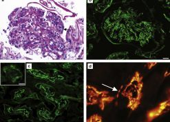 Anti–brush border antibody disease and lupus nephritis