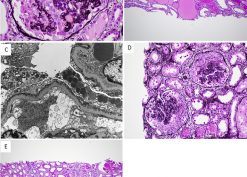 Kidney Biopsy Findings in Patients With COVID-19, Kidney Injury, and Proteinuria