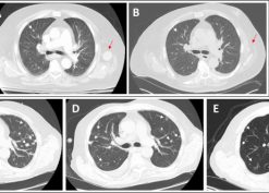 Radiographic improvement in disease