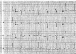 Electrocardiogram with short PR interval and delta wave