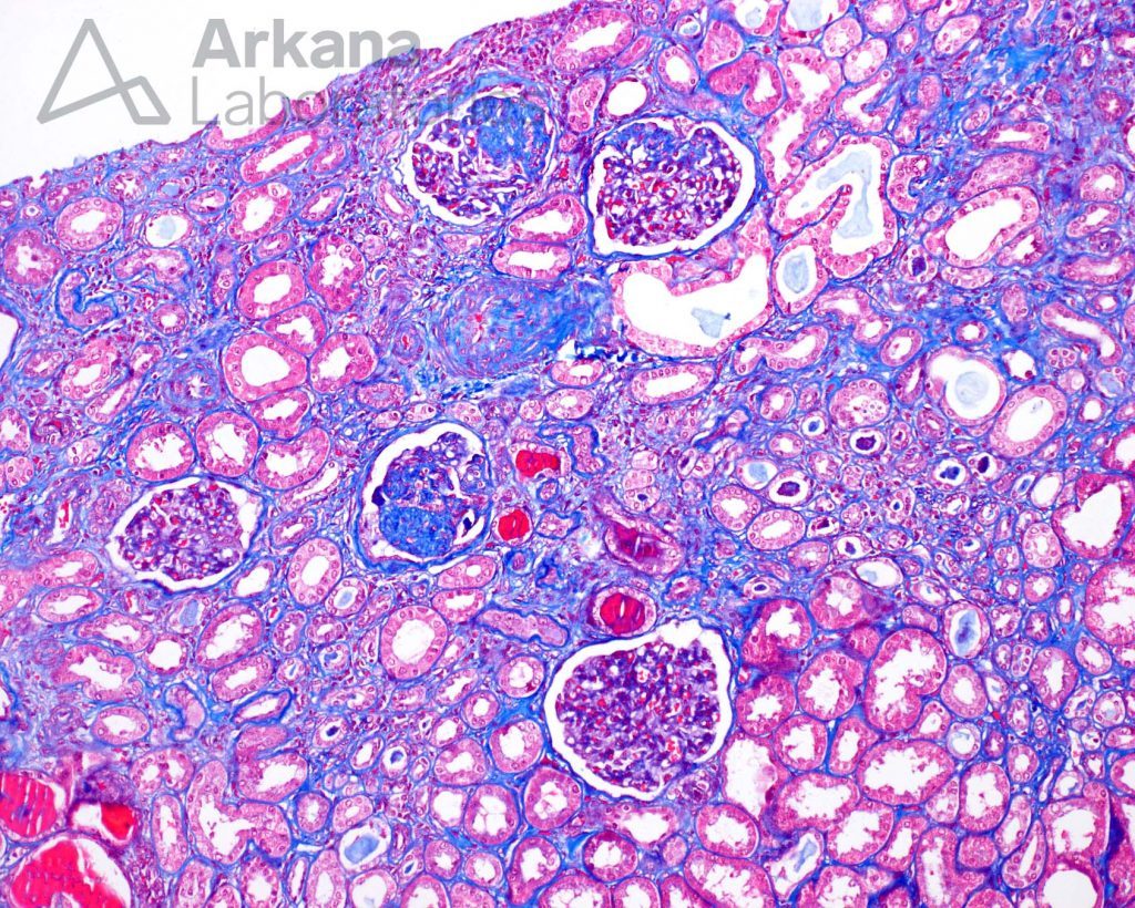 Focal And Segmental Glomerulosclerosis | Diagnose This! | Arkana Labs