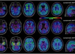 18F-MK-6240 tau-PET In Genetic Frontotemporal Dementia