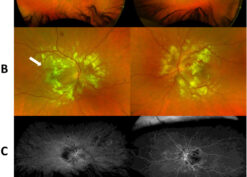 fundus photos and fluorescein angiography