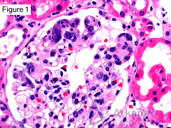 Intravascular B-Cell Lymphoma | Diagnose This! | Arkana Laboratories