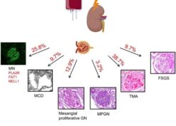 Glomerular diseases post-hematopoietic stem cell transplantation