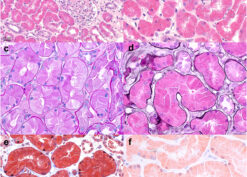 Lysozyme-Associated Nephropathy