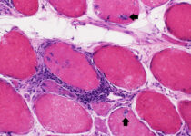 Sporadic inclusion body myositis