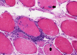 Sporadic inclusion body myositis