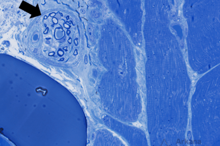 Figure 1: Toluidine blue stained thick section 600x original magnification