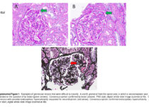 Cure Glomerulonephropathy Pathology Classification and Core Scoring Criteria