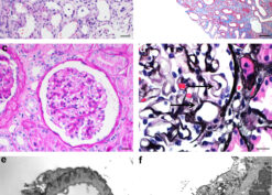 antibrush border antibody disease