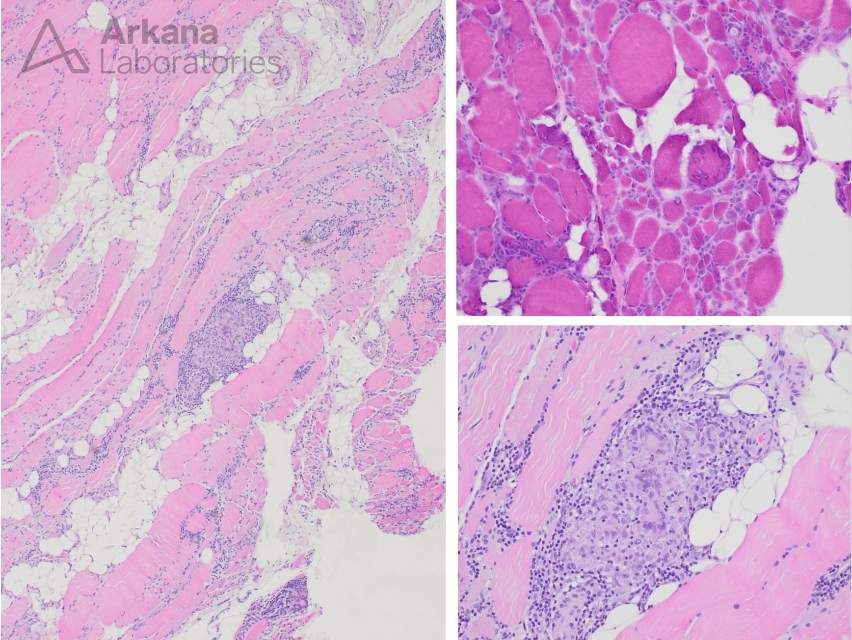 Granulomatous myopathy