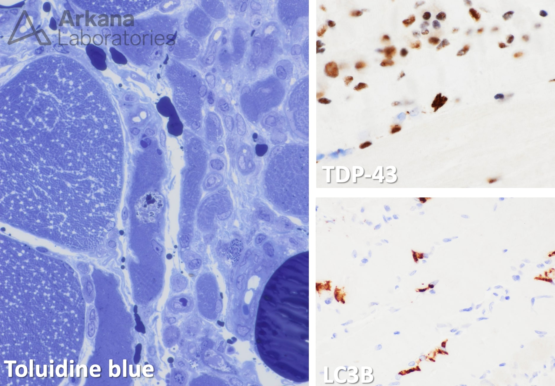 Granulomatous myopathy