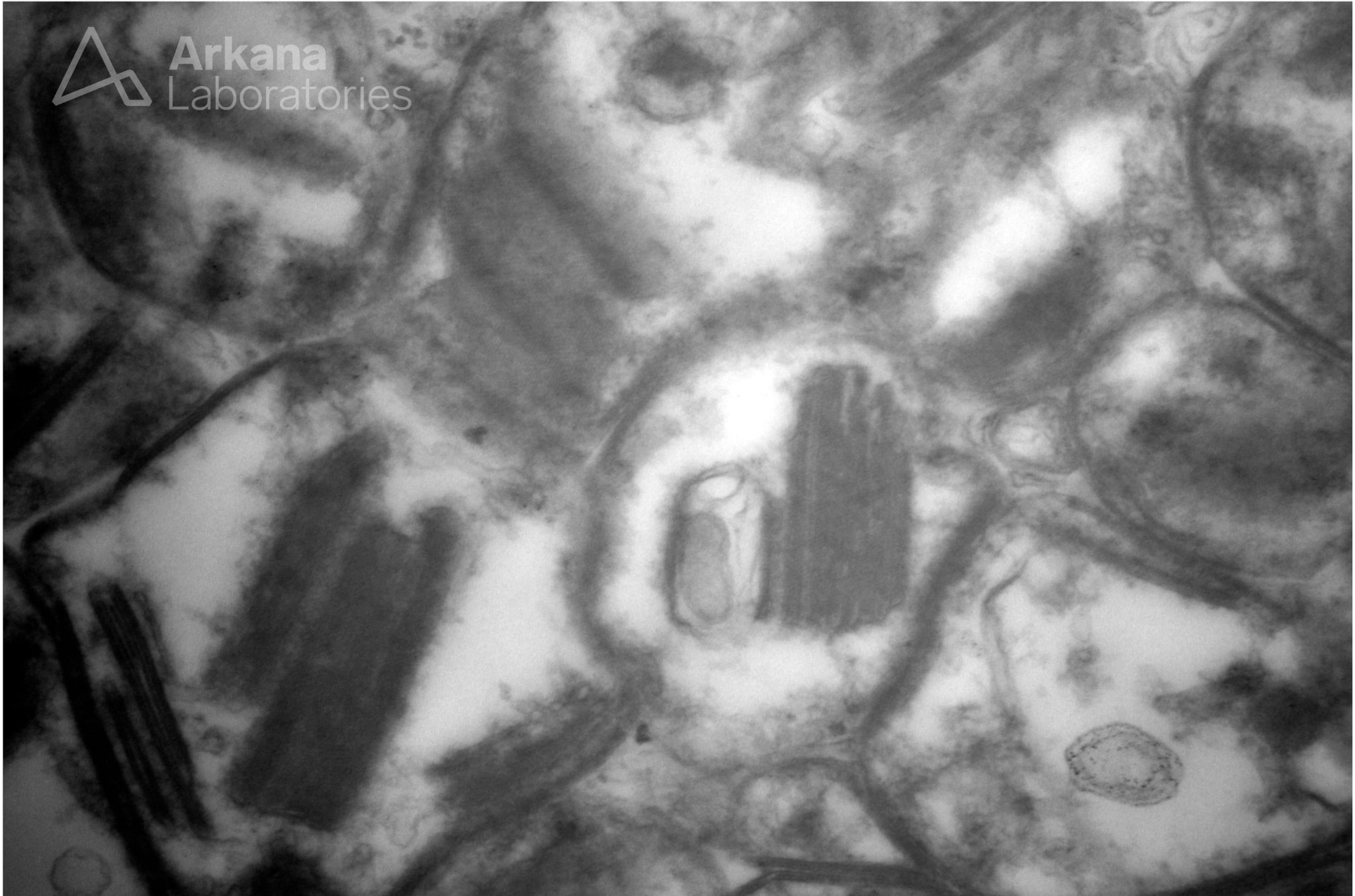 Mitochondrial myopathy