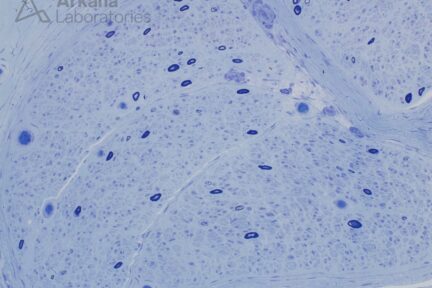 Neuropathy Associated with Amyloid