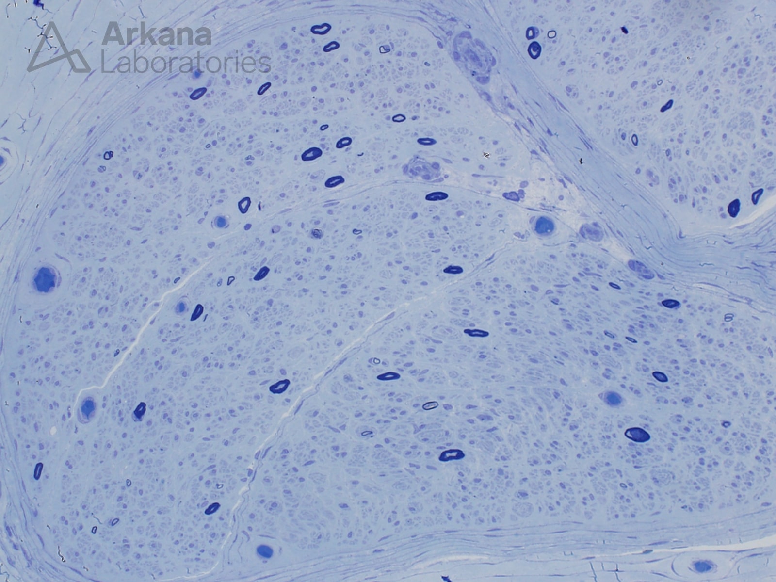 Neuropathy Associated with Amyloid