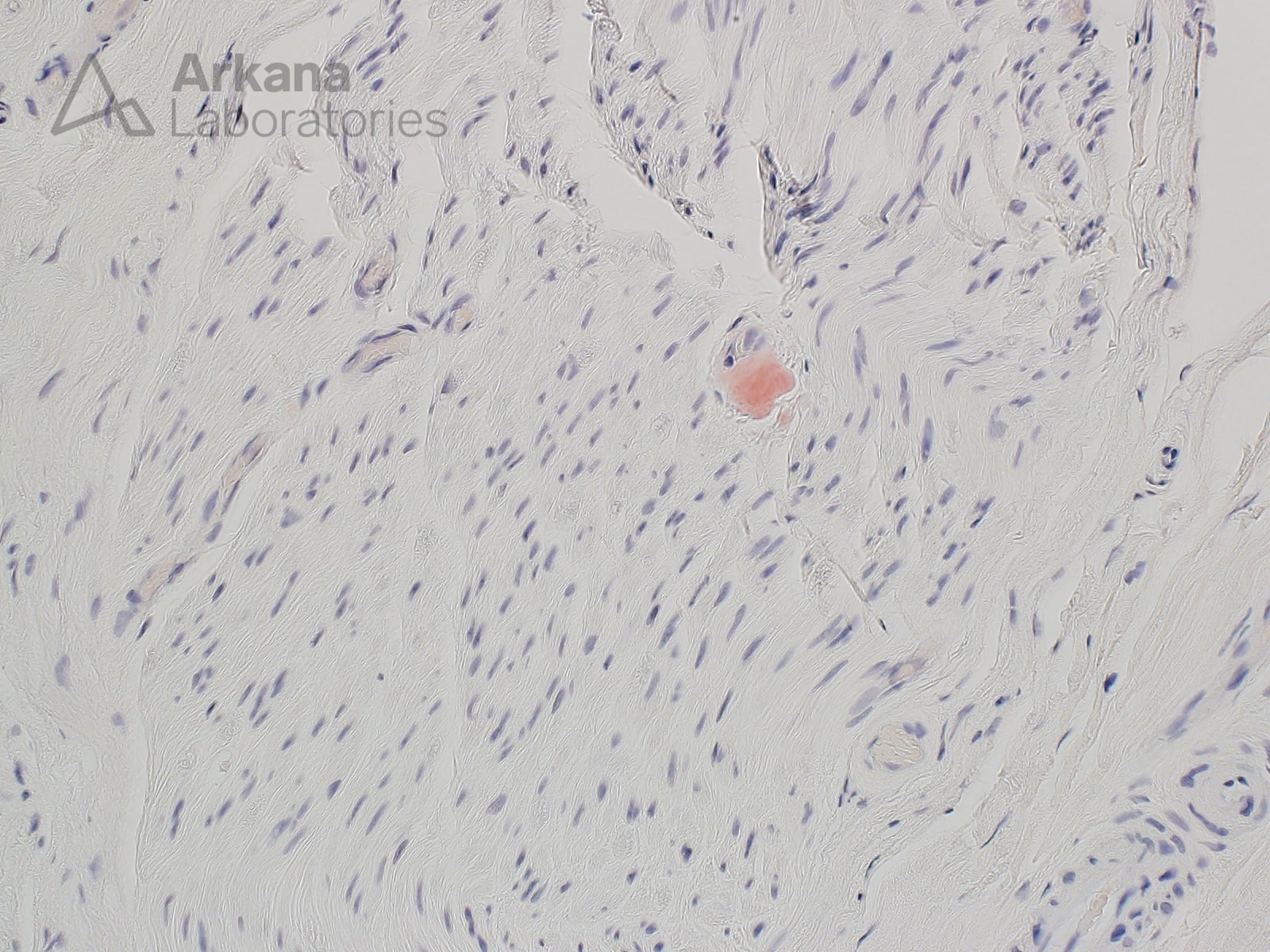 Neuropathy Associated with Amyloid