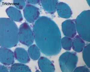 Nemaline Myopathy