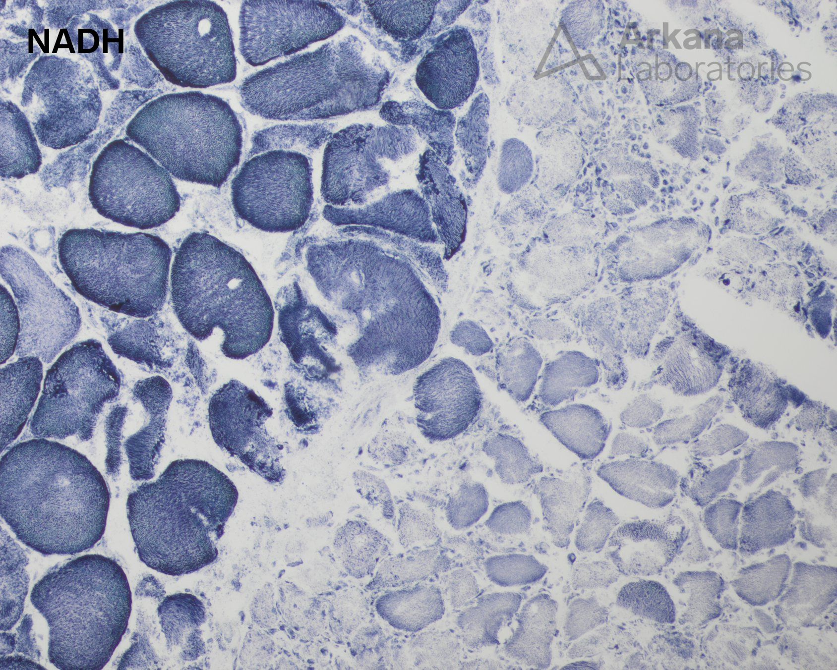 McArdle disease