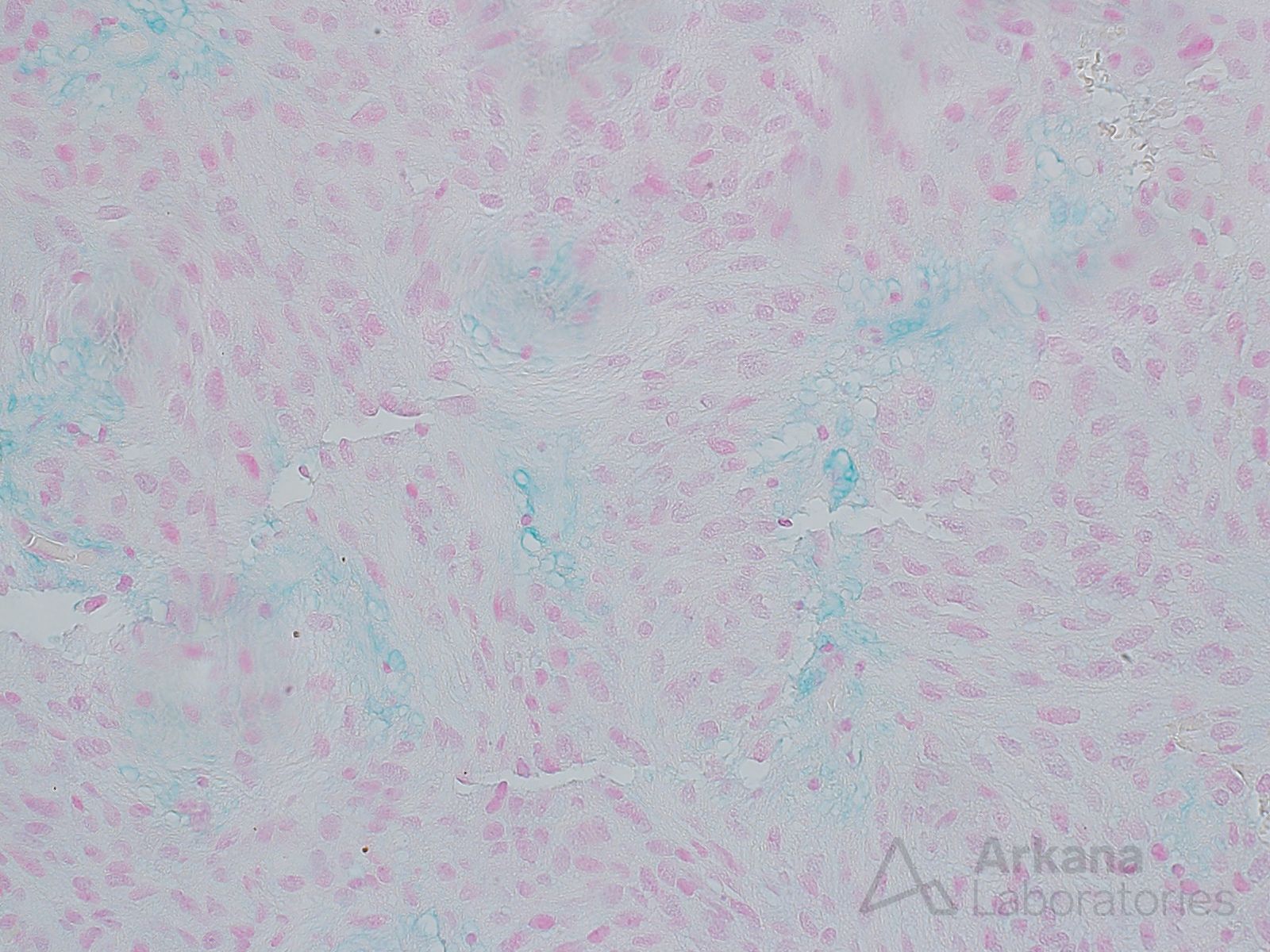 Myxopapillary Ependymoma