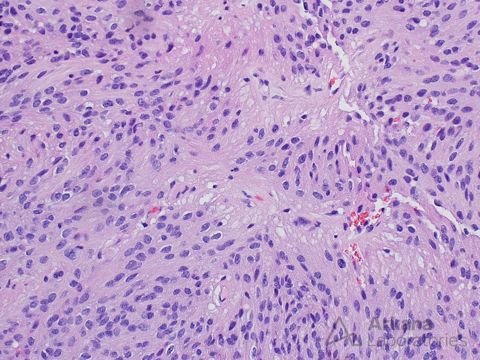 Myxopapillary Ependymoma