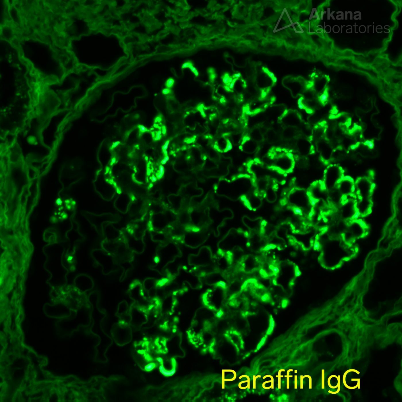 Masked Igg Kappa Deposits Teaching Points Arkana Laboratories