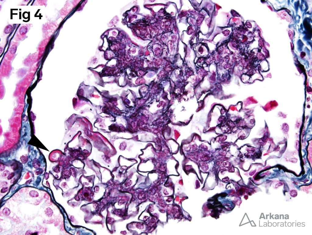 Class Iii Focal Lupus Nephritis Teaching Points Arkana Laboratories 3480