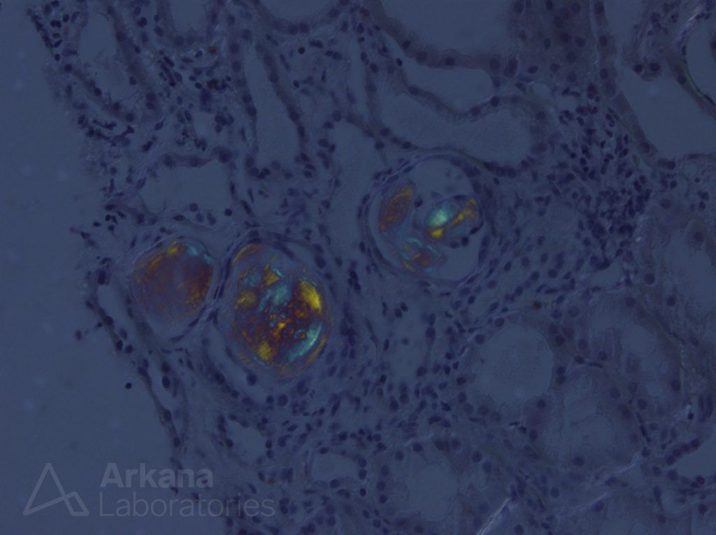 Amyloid Cast Nephropathy Teaching Points Arkana Laboratories