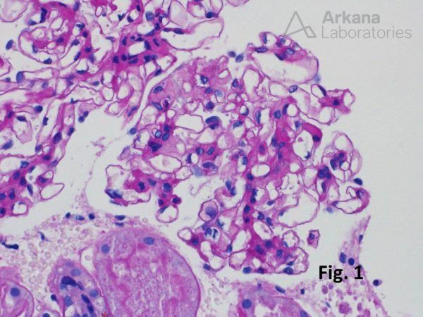 Iga Nephropathy Im Teaching Point Arkana Laboratories