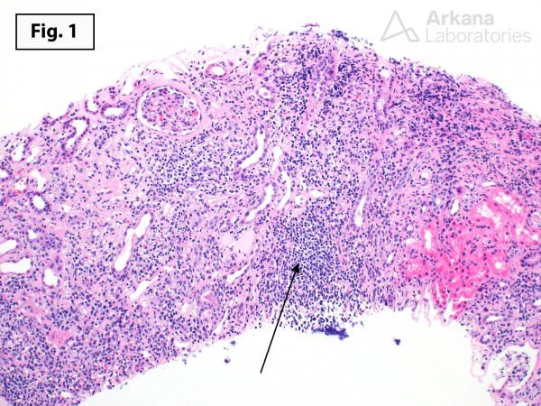 Chronic Active T Cell-Mediated Rejection | Teaching Points