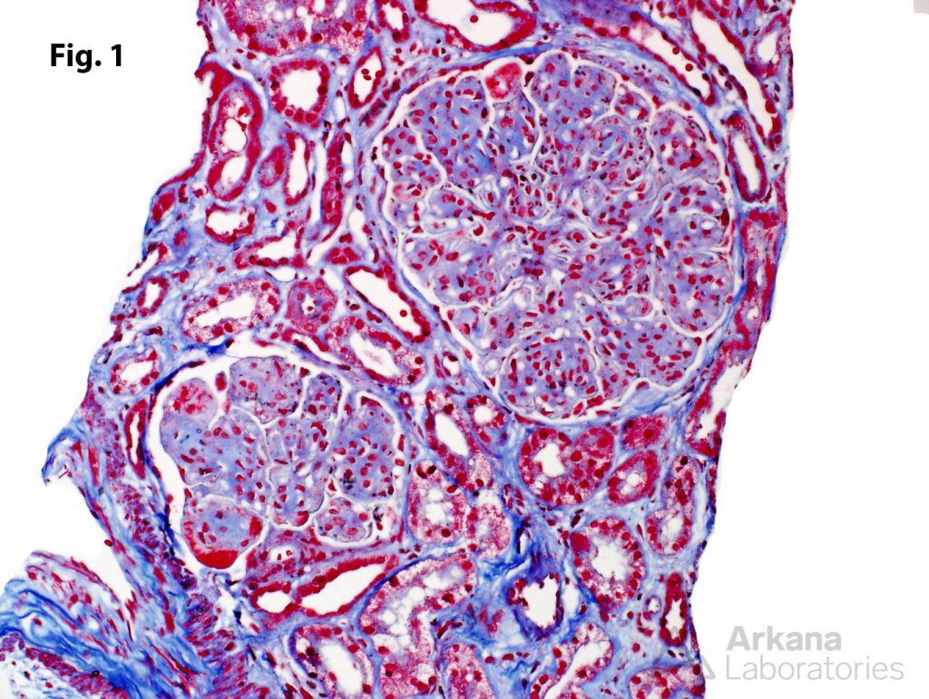 Immunotactoid Glomerulopathy Teaching Points Arkana Laboratories