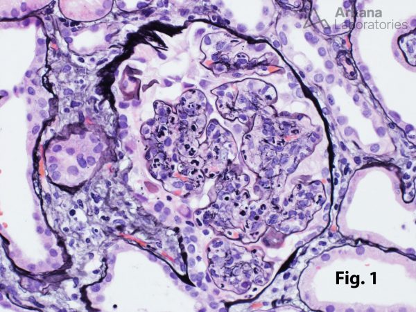 Infection-Associated Glomerulonephritis | Teaching Point | Arkana Labs